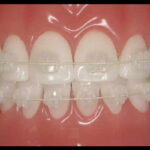 Say Goodbye To Metal Braces: The Advantages Of Ceramic Braces
