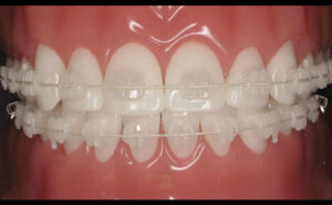 Say Goodbye To Metal Braces: The Advantages Of Ceramic Braces
