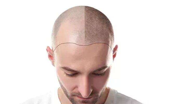 How Much Does FUE Hair Transplant Cost In Turkey?
